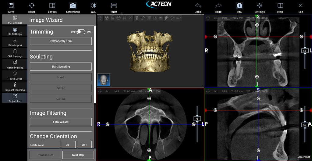 Screen shot of CBCT scan results